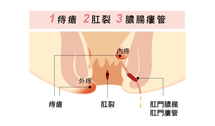 引起血便的原因：1. 痔瘡、２.肛裂、３.肛門膿瘍