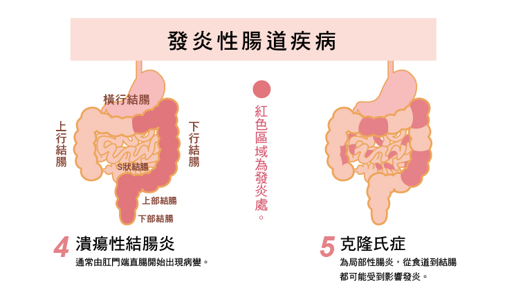 引起血便的原因：發炎性腸道疾病